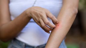 Domowe sposoby na ukąszenie komara. Te patenty to mistrzostwo