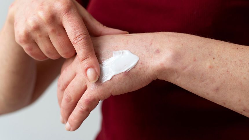 Maść dziegciowa to remedium na suchą skórę i trądzik