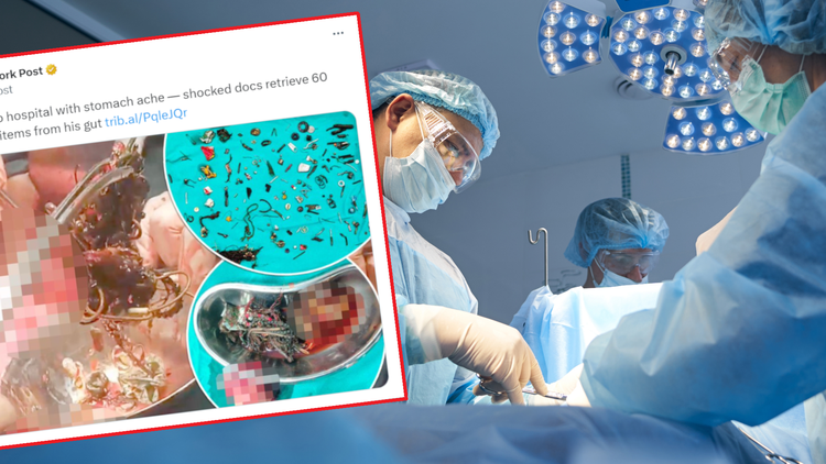 Mężczyzna połknął 60 różnych przedmiotów