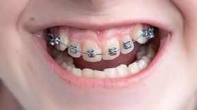 stały aparat ortodontyczny
