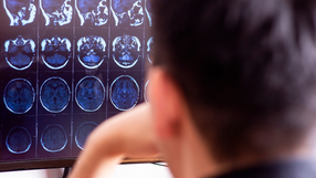 Polski lek na alzheimera