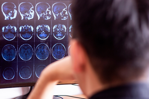 Polski lek na alzheimera