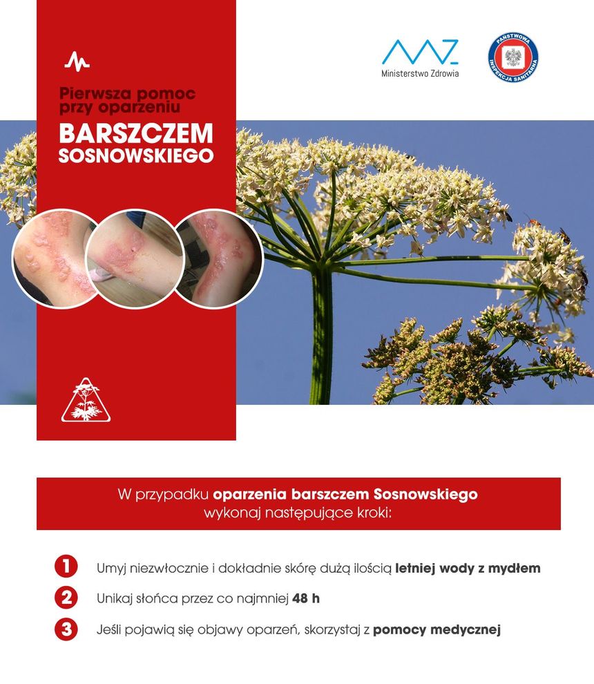 poparzenie barszczem Sosnowskiego