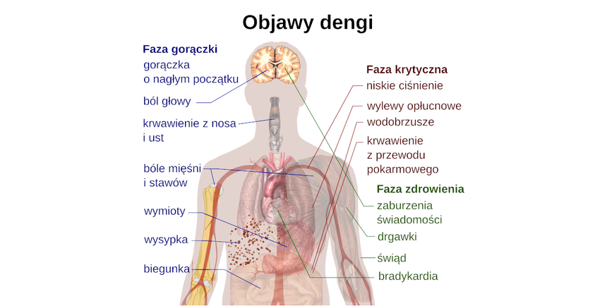 objawy dengi