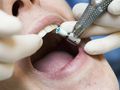 Zdjęcie przedstawia dentystę wykonującego zabieg w jamie ustnej pacjenta.