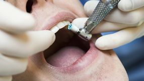 Zdjęcie przedstawia dentystę wykonującego zabieg w jamie ustnej pacjenta.